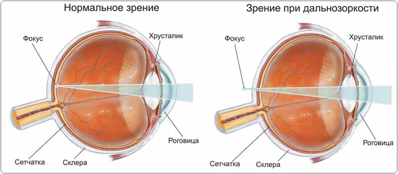 Хирургическая лазерная коррекция дальнозоркости. Николаев. Офтальмологический центр.
