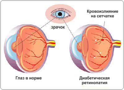 Діабетична ретинопатія. Лікування в офтальмологічному центрі в Миколаєві.